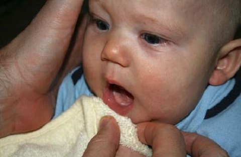 Trẻ bị tưa lưỡi - Nguyên nhân và cách điều trị theo kinh nghiệm dân gian