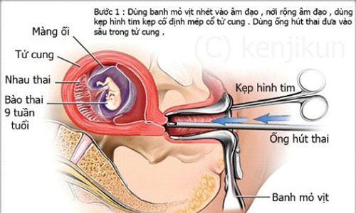 phương pháp phá thai an toàn 2