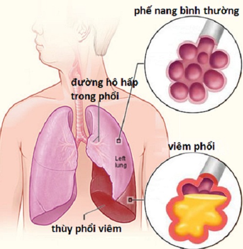 trẻ bị viêm phế quản phổi 2