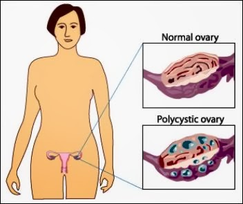 Những bệnh ở nữ giới dễ gây vô sinh
