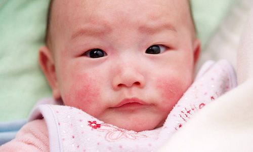 Bệnh mẩn ngứa ở trẻ và cách chăm sóc bé khi bị mẩn ngứa