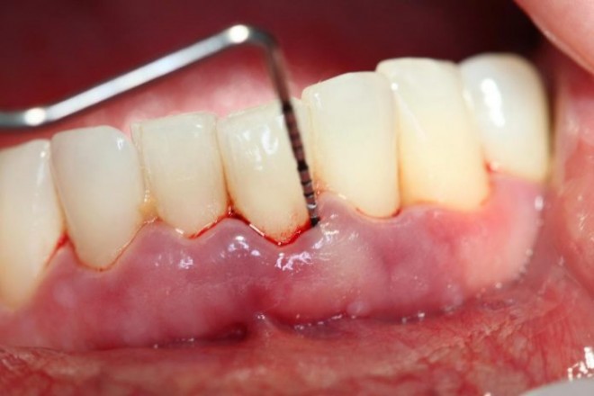 Thói quen hàng ngày khiến 90% người Việt SÂU RĂNG, viêm lợi, mất răng… Bạn có mắc phải?